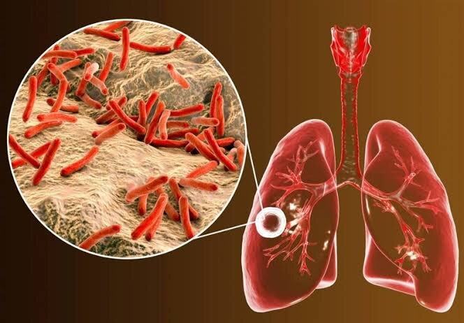 بیماریابی ۱۱۶ مورد مشکوک به سل در بیجار طی شش‌ماهه نخست سال